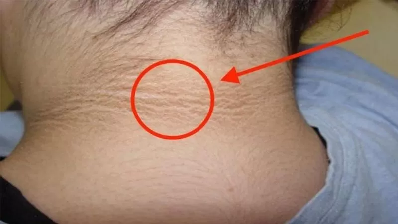 NGƯỜI MẮC BỆNH LÝ VỀ CHUYỂN HÓA