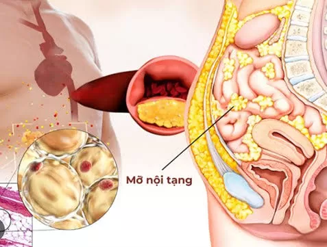 NGƯỜI CÓ MỠ NỘI TẠNG LỚN